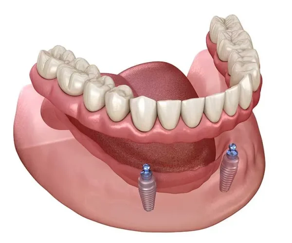 Snap-on-denture-implants in Kansas City, KS