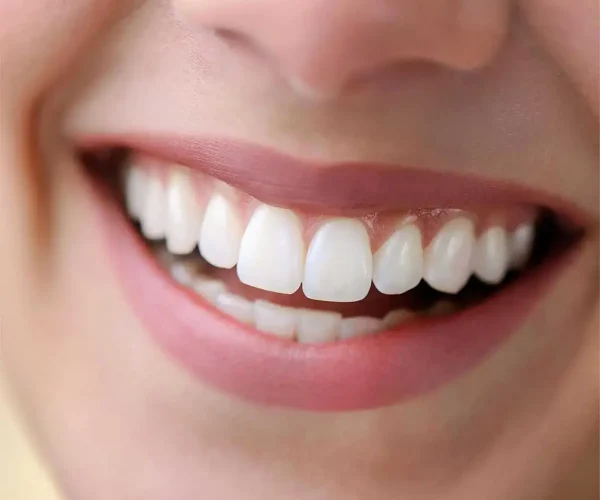 veneers in Kansas City, KS at Gordon Dental