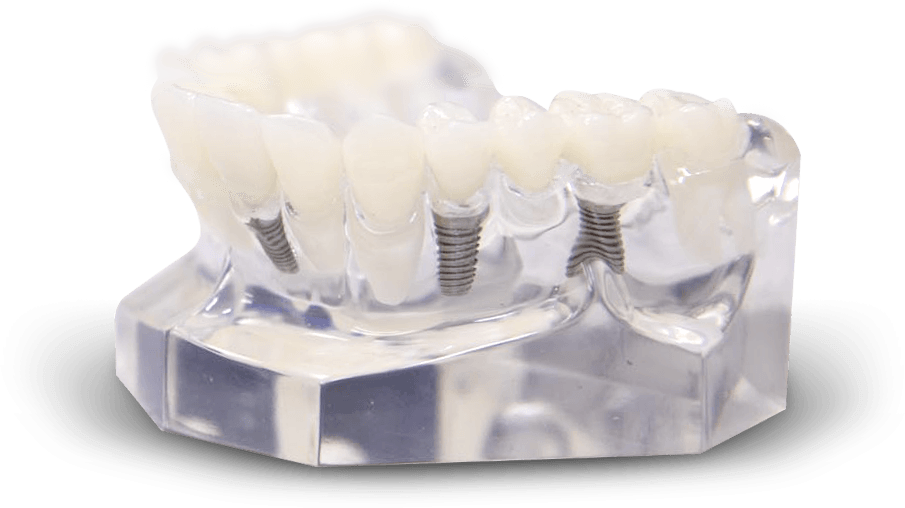 dental implants leawood ks