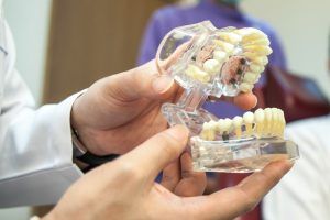 Top 4 Benefits of Full Arch Dental Implants