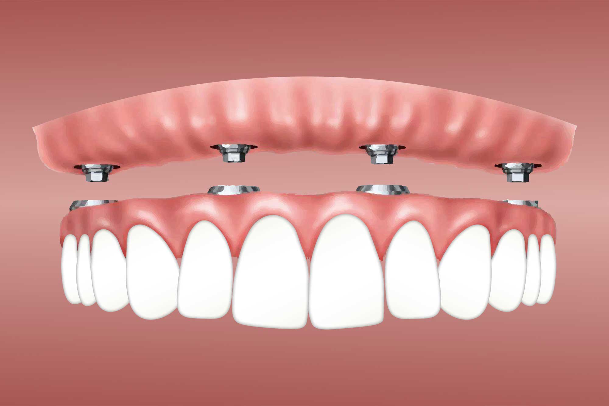 Dental Implant Procedure: What You Need To Know - Gordon Dental Implants &  Cosmetics