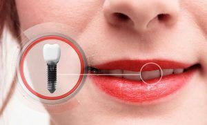 women thinking about if dental implants are safe
