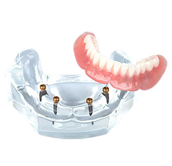 implant over-denture solution for loose dentures