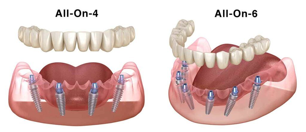 All on 6 dental implants vs all on 4