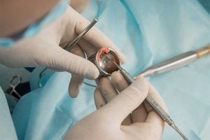 Bone Grafting for implants