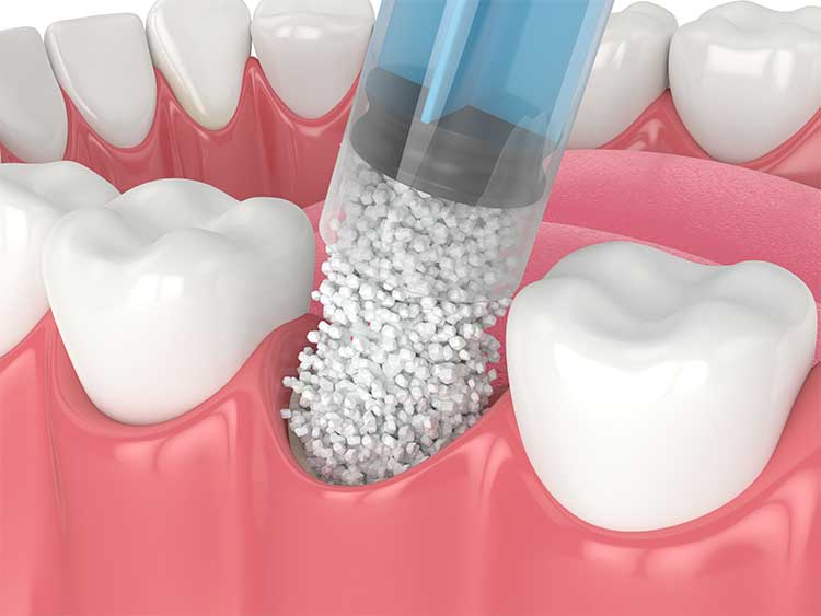 dental bone graft material