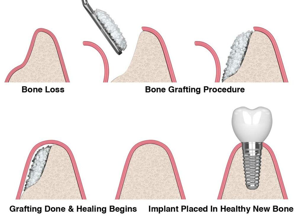 dental bone graft procedure and the process