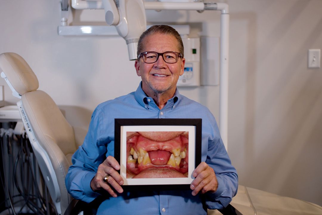 Steve's Before and After Dental Implants