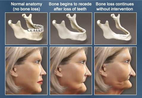 Bone loss facial jawbone graft