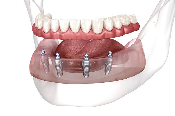 Full Mouth Dental Implants in Kansas City and Overland Park