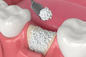 Dental Bone Grafting Procedure