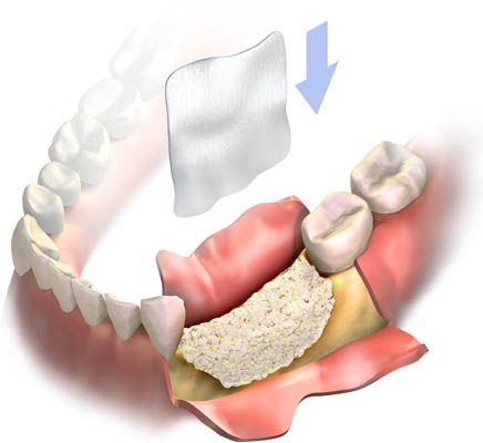 Who qualifies for dental bone grafting?