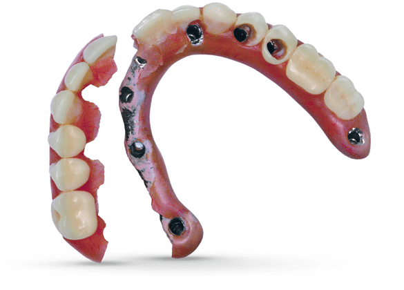 Broken acrylic all on for dental implants