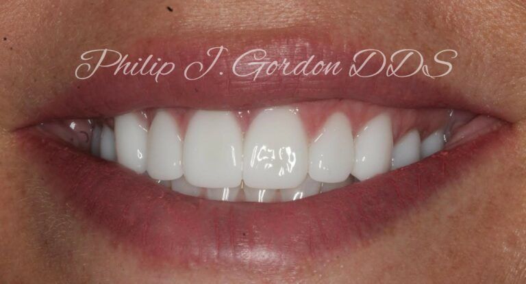 Before and After Veneers Kansas City