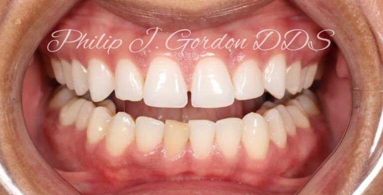 Before and after dental veneers Kansas City and Overland Park Kansas