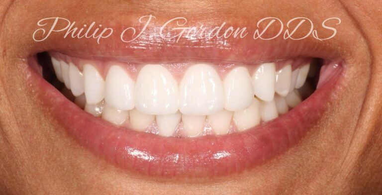 Before and after dental veneers Kansas City and Overland Park Kansas