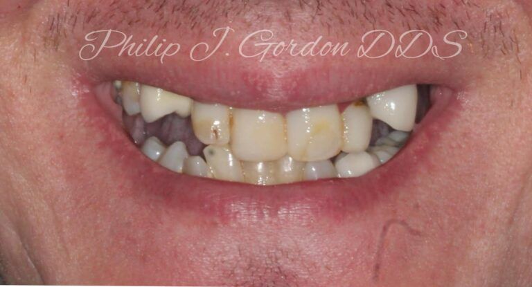 Full mouth Dental implants before and after case by Gordon Dental Implants and Cosmetics Overland Park and Kansas City