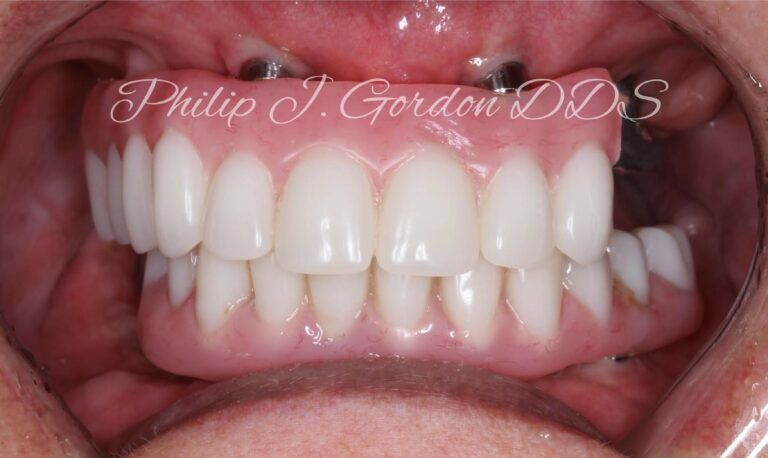 Dental implants before and after case by Gordon Dental Implants and Cosmetics Overland Park and Kansas City