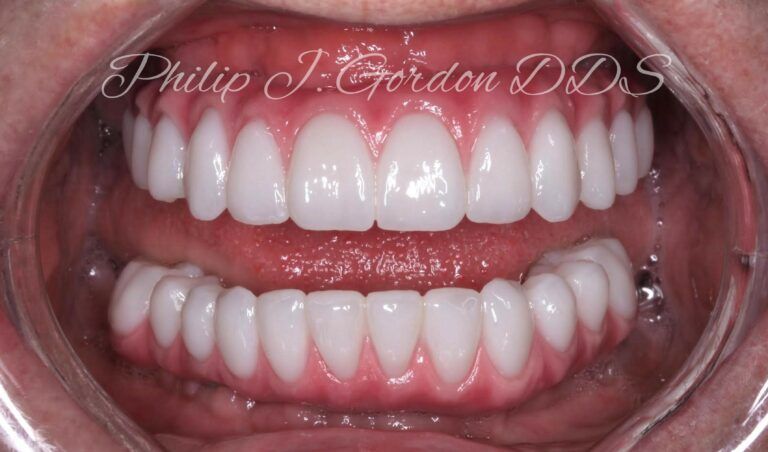 Dental implants before and after case by Gordon Dental Implants and Cosmetics Overland Park and Kansas City