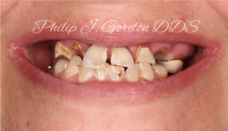 Full Mouth Dental Implants Kansas City, Overland Park, Leawood Kansas