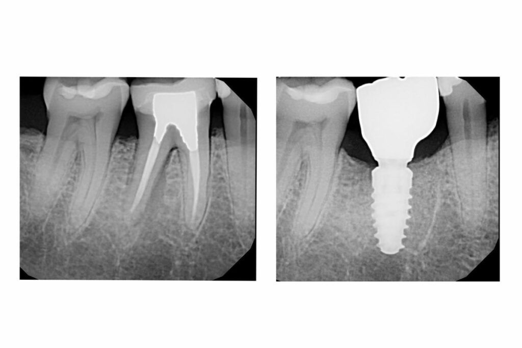 X-rays of failing root canal replaced with a dental implant