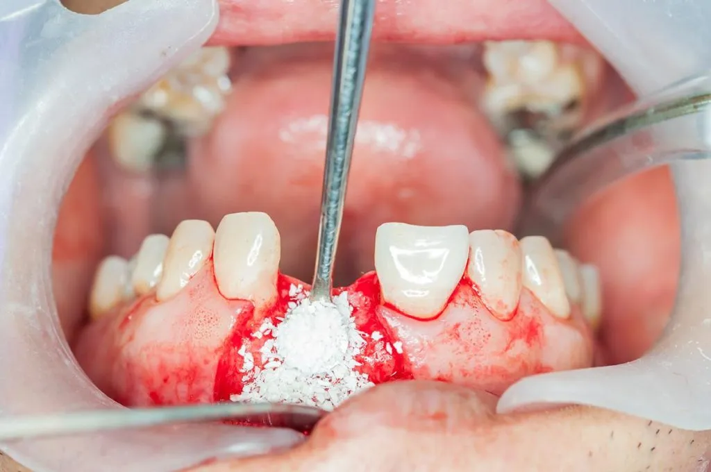Dental Bone Grafting in Kansas City at Gordon Dental Implants and Cosmetics