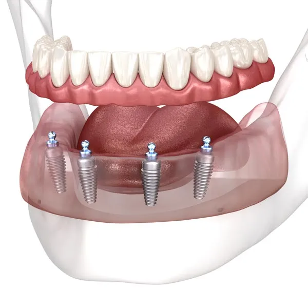 Clear and Best Choice for Dental Implant Snap-On Dentures