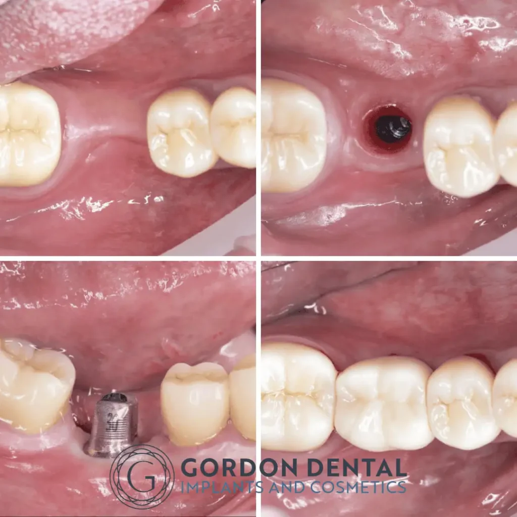 Illustration of replacing a failed root canal-treated tooth with a dental implant