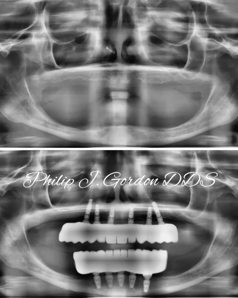 Before-and-after X-ray of All-on-4 dental implants at Gordon Dental