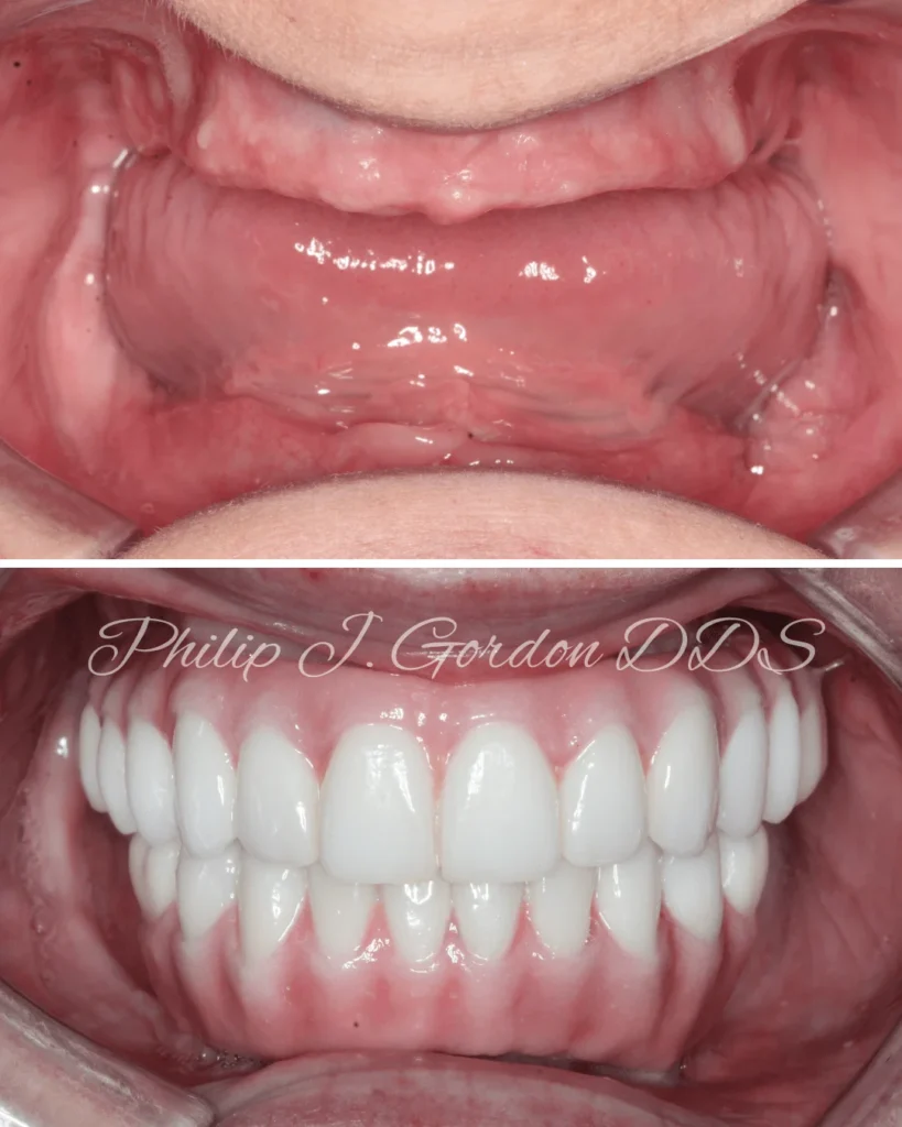 Before-and-after image of All-on-4 full-arch implants in Kansas City