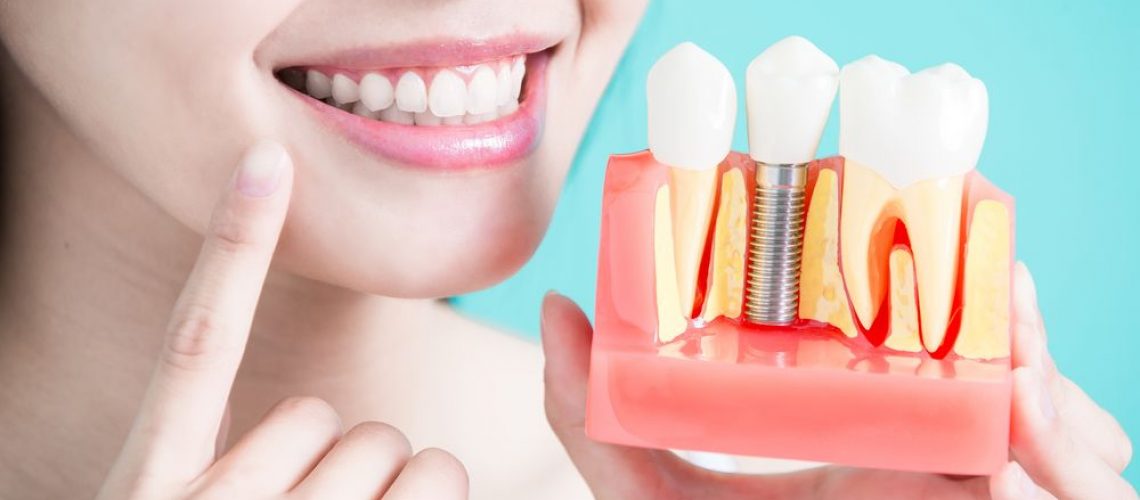 Regaining Your Confidence with Dental Implants
