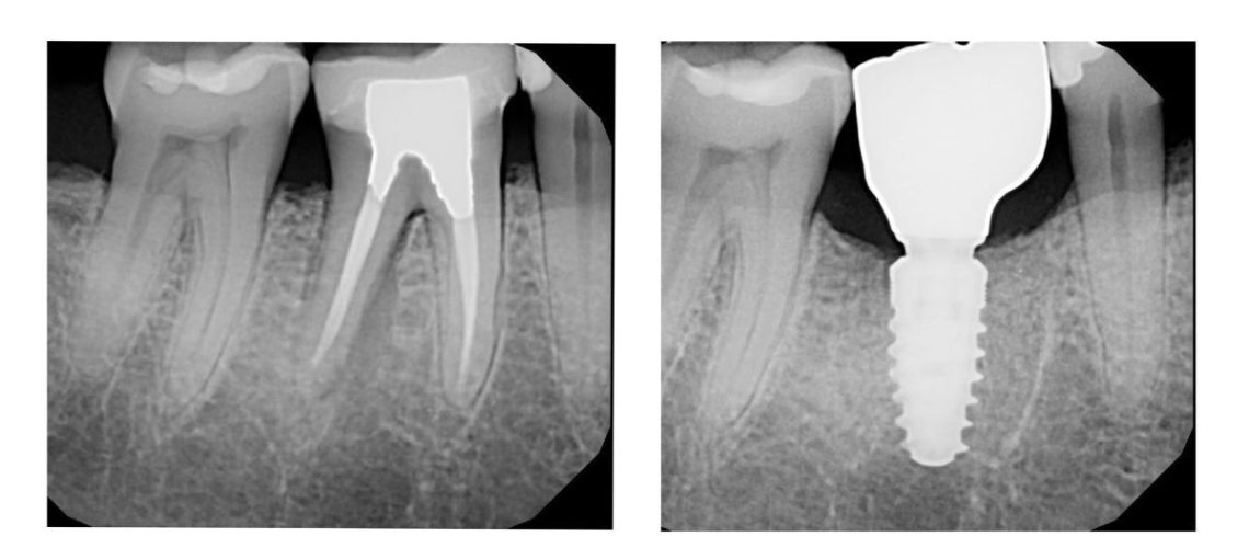 X-rays of failing root canal replaced with a dental implant