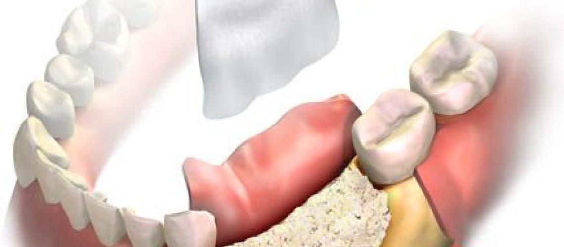 Who qualifies for dental bone grafting?