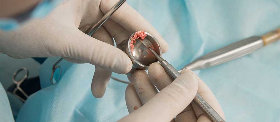 bone-grafting-for-implants-procedure