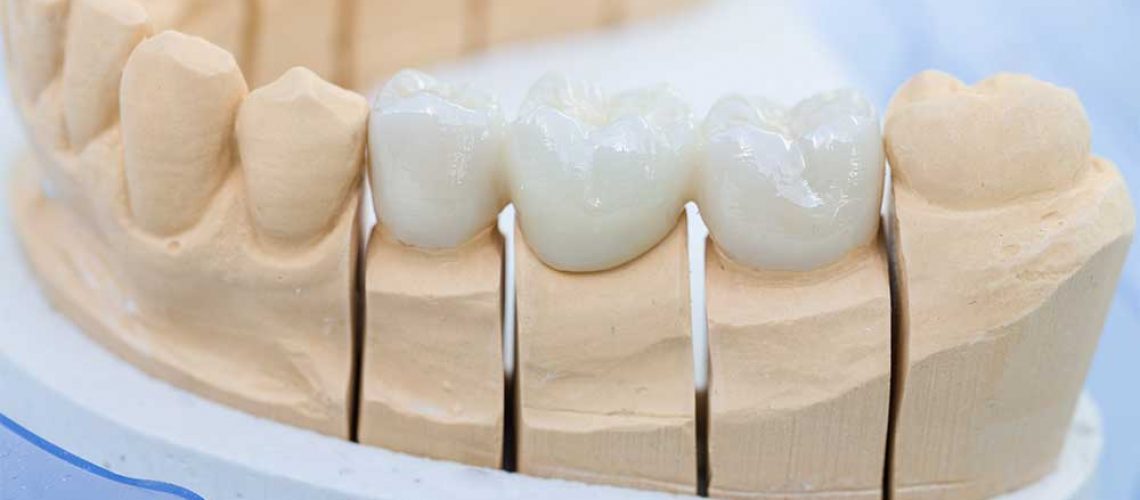 dental-bridge-vs-dental-implant-restoration