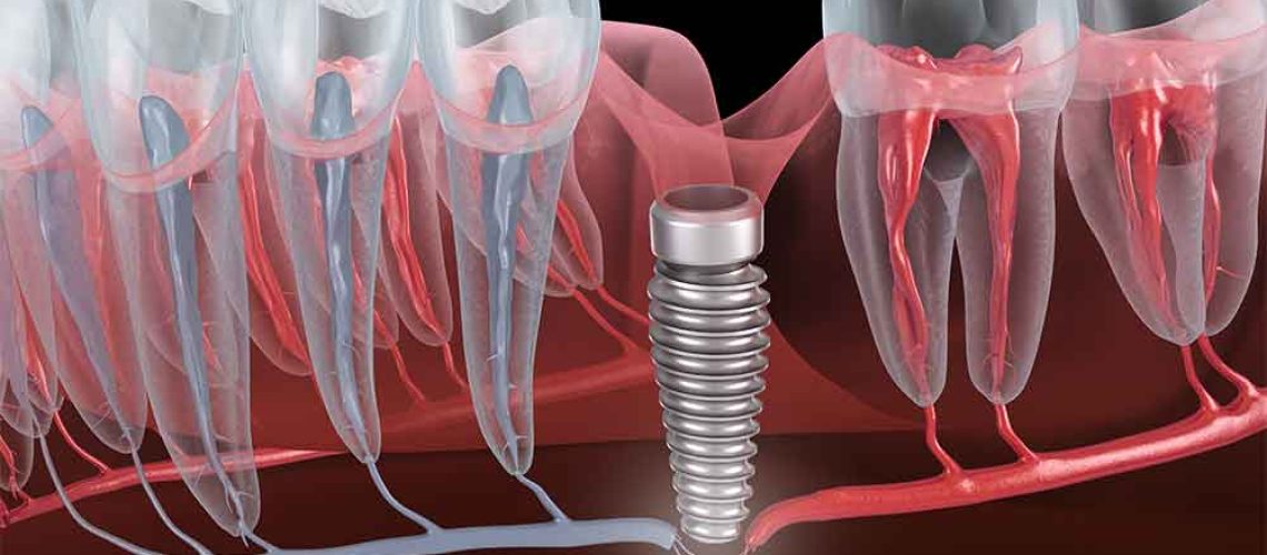 dental-implant-failure