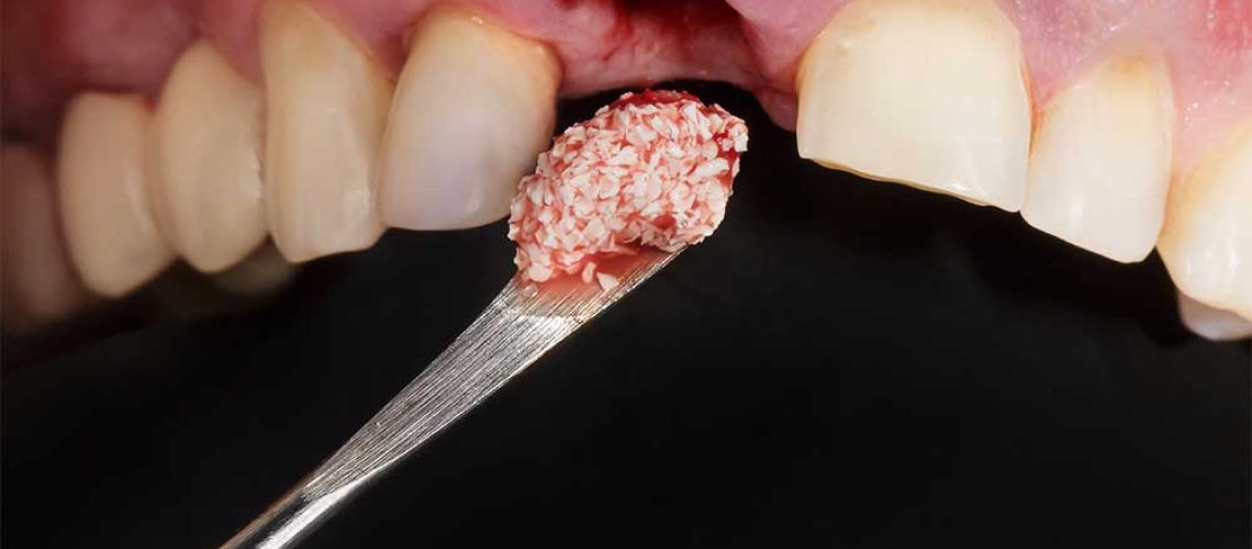 dental-implant-patient-bone-graft
