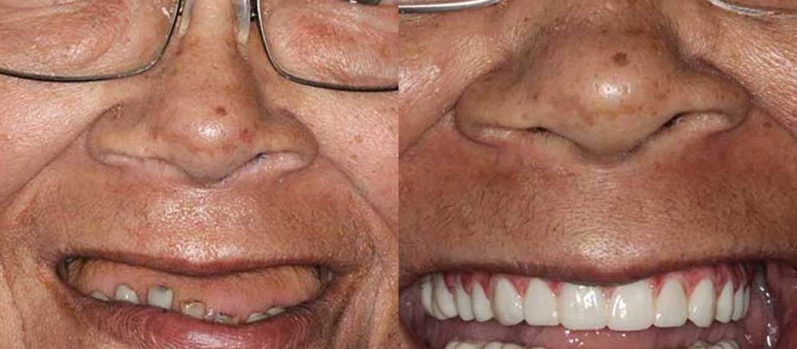 full-mouth-reconstruction-before-after