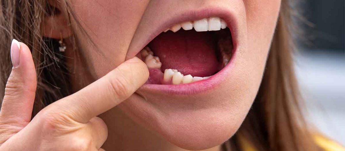 molar-tooth-loss-female