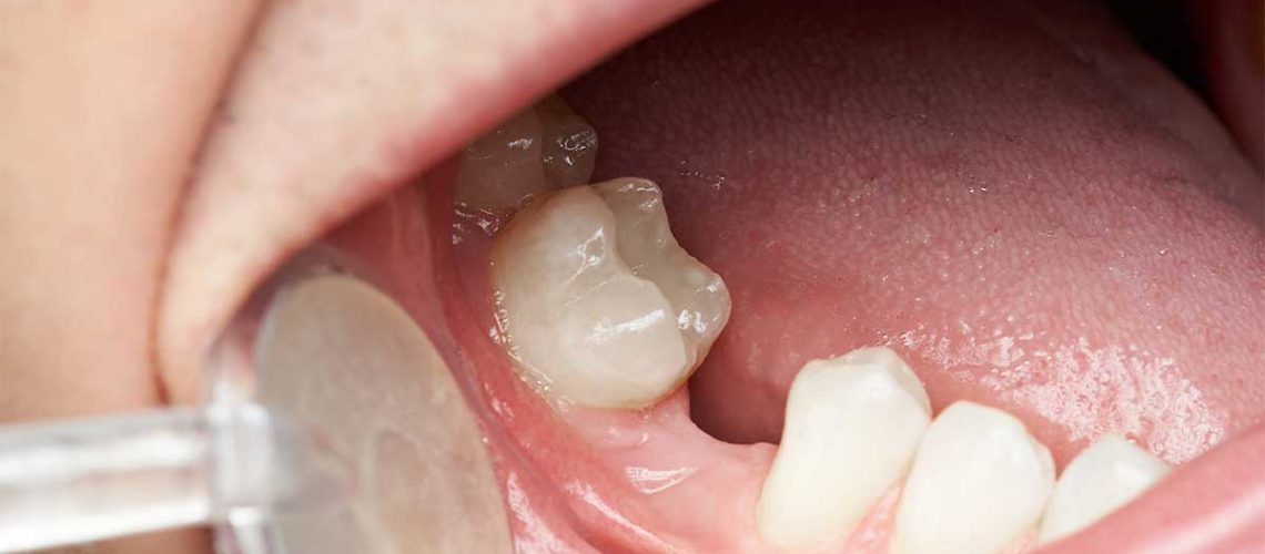 effects of not replacing missing teeth