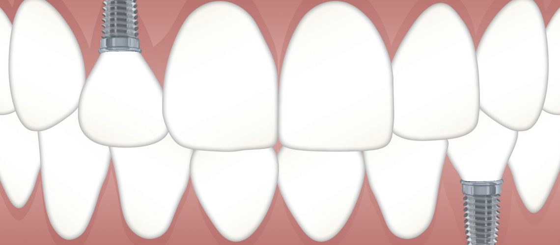 teeth-replacement-options