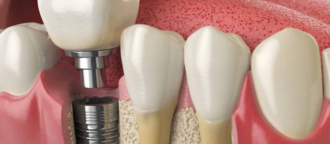 Dental implants in Leawood, KS Business located at 38.9576186 -94.6279488